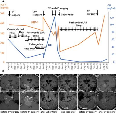 Temozolomide and Capecitabine Treatment for an Aggressive Somatotroph Pituitary Tumor: A Case Report and Literature Review